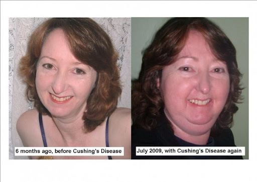Cushing's Syndrome Signs and Symptoms